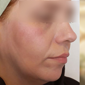 نمونه کار تزریق چربی خانوم حسینی