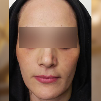 نمونه تزریق چربی صورت خانم بیدا