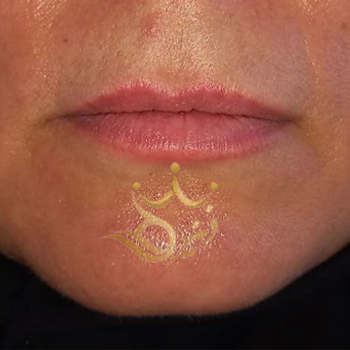 نمونه کار تزریق ژل خانم حسینی