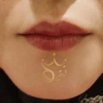 نمونه کار تزریق ژل لب خانم یحیی