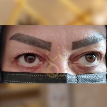 بلفاروپلاستی خانوم صابری