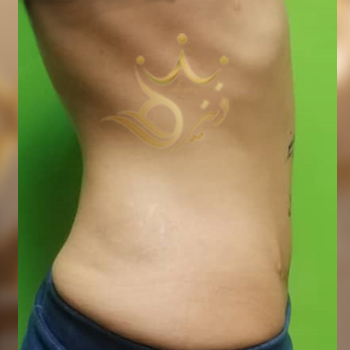 نمونه کار ابدومینوپلاستی خانوم بهرامی