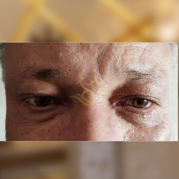 نمونه کار کاشت ابرو اقای محمدی
