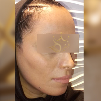 تزریق ژل صورت خانوم نوری