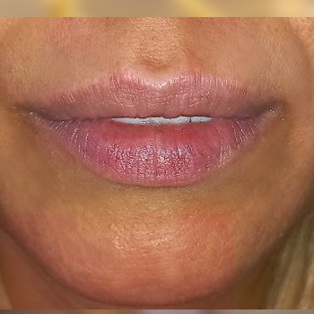 نمونه تزریق ژل لب خانوم پارسایی