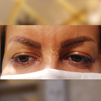 بلفاروپلاستی خانوم رحمانی