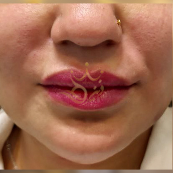 نمونه ژل خط خنده خانم سالاری