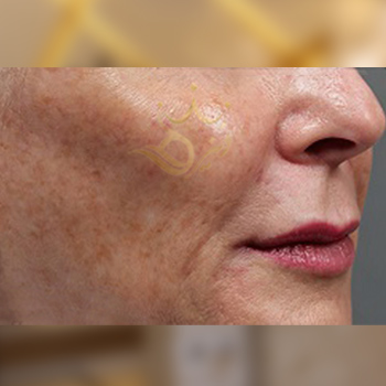 نمونه کار لیزر جنسیس خانم مرادی