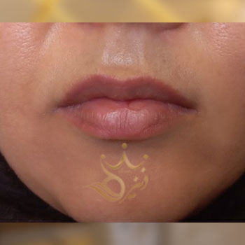 نمونه کار تزریق ژل لب خانم راد