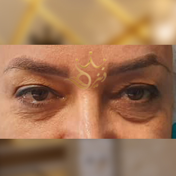 نمونه کار بلفاروپلاستی خانم خلیلی