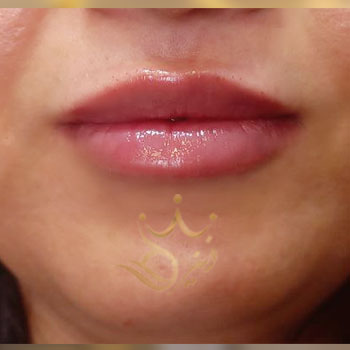 تزریق ژل لب خانوم محتشم