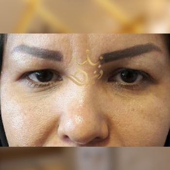 نمونه کار بلفاروپلاستی خانم رامشینی