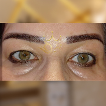 نمونه کار بلفاروپلاستی خانم کلاته