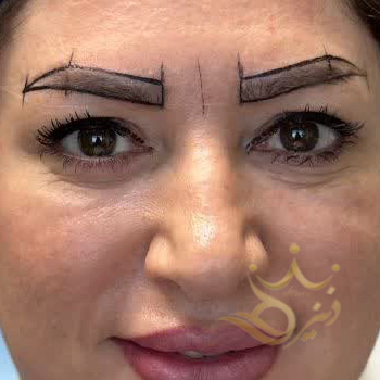 کاشت ابرو مشهد خانم غلامی