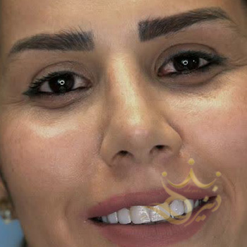 کاشت ابرو مشهد خانم ترکاشوند