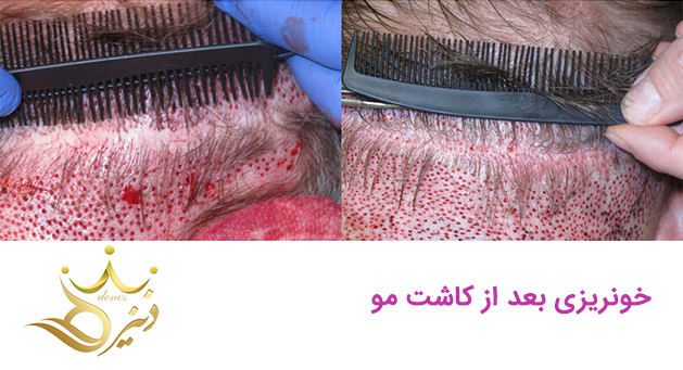 خونریزی بعد از کاشت مو