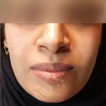 نمونه تزریق ژل گونه خانوم لیلاپور