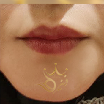 نمونه کار تزریق ژل لب خانم پاشایی