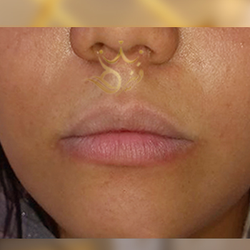 نمونه کار تزریق ژل لب خانم جاجرمی