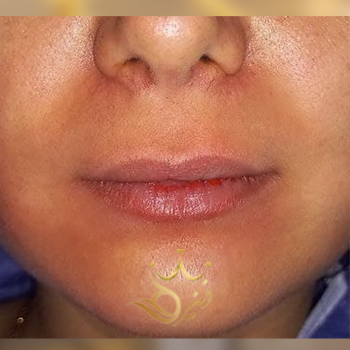 نمونه کار تزریق ژل لب خانم مریم