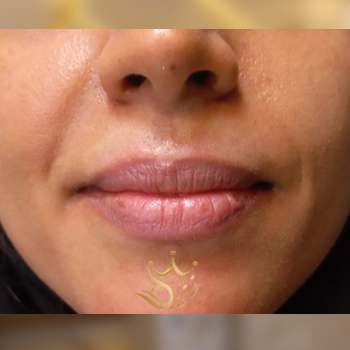 نمونه کار تزریق ژل لب خانم پروانه