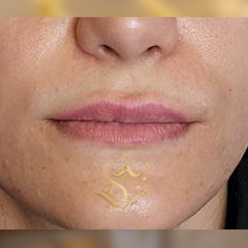 نمونه کار تزریق ژل لب خانم خاکسار