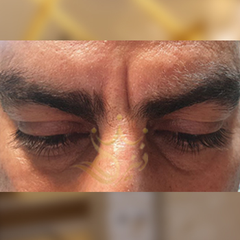 نمونه کار تزریق ژل اقای پاسبانی