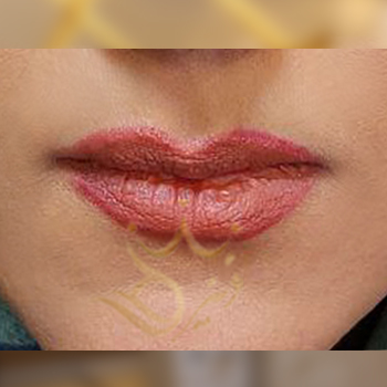 نمونه کار تزریق ژل لب خانم شمسایی