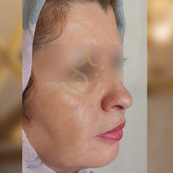 نمونه کار تزریق چربی صورت خانم سیمین