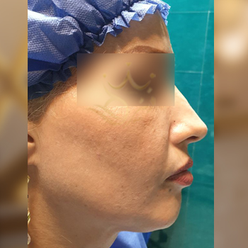 نمونه کار تزریق چربی صورت خانم بهرامی