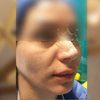 نمونه کار تزریق چربی صورت خانم خرمی