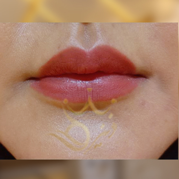 نمونه کار تزریق ژل لب خانم سالاری