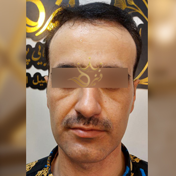 نمونه کار تزریق چربی صورت اقای ملکیان