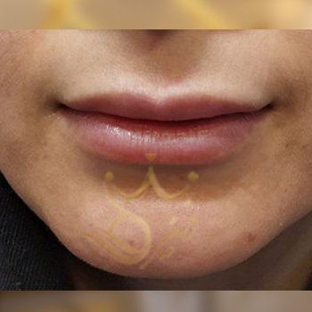نمونه کار تزریق ژل لب خانم ناصری