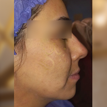 نمونه کار تزریق چربی خانم مقدسی