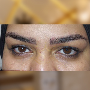 نمونه کار بلفاروپلاستی خانم خرم آبادی