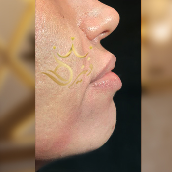 نمونه کار تززیق ژل چانه خانم بهمنی