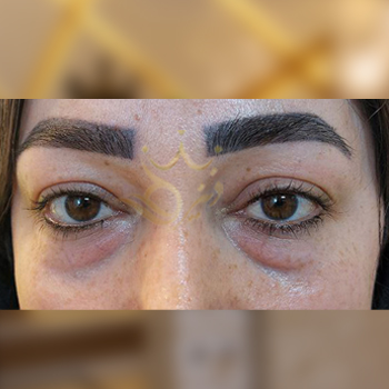 نمونه کار بلفاروپلاستی سرکار خانم ژیان