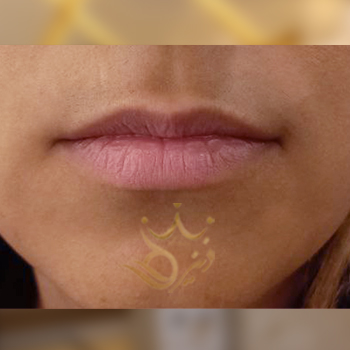 نمونه تزریق ژل لب خانم رحمتی