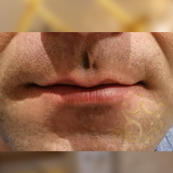 نمونه کار تزریق ژل لب آقای رضوی
