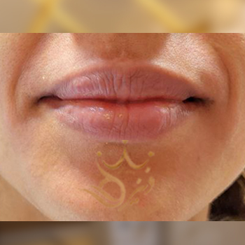 تزریق ژل لب خانم علینژاد