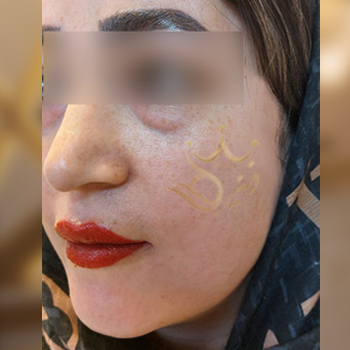 تزریق چربی صورت خانم گرگانی