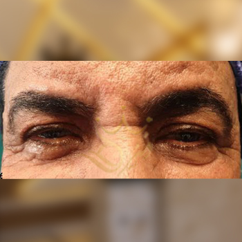 نمونه کار بلفاروپلاستی آقای غلامی