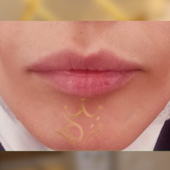 نمونه کار تزریق ژل لب خانم مهرانفر