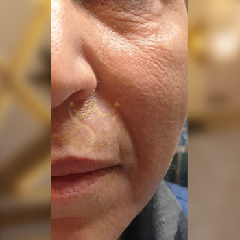 نمونه تزریق ژل خط خنده خانم میرزازاده