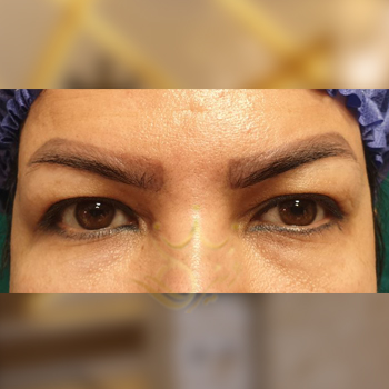 نمونه کار بلفاروپلاستی خانم حیدرزاده