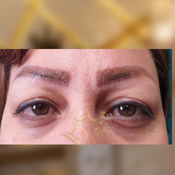 نمونه کار بلفاروپلاستی خانم براتی