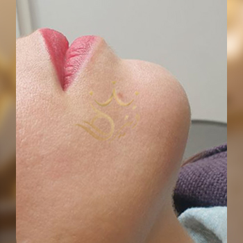 نمونه کار تزریق ژل چانه خانم دلدار