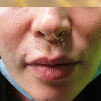 تزریق ژل خط خنده خانم رمضانزاده