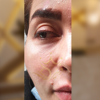 نمونه کار تزریق ژل زیر چشم خانم سرمدی